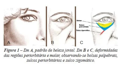 Preenchimento da maçã do rosto com Dermatologista restylane