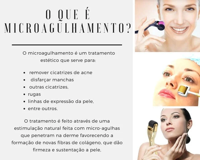 o-que-é-microagulhamento-saopaulo-dermapen