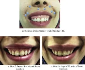 botox para sorriso gengival
