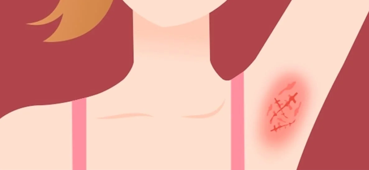 especialista hidradenite