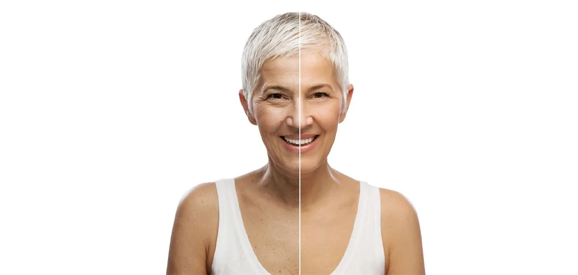 Como tratar o pé de galinha tratamteno rugas do pé de galinha