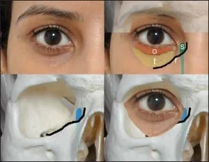 tratamento de olheira