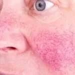 tratamento veia do nariz