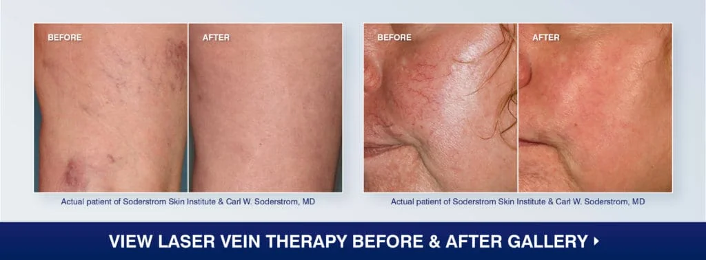 tratamento veia testa nariz e redor olhos