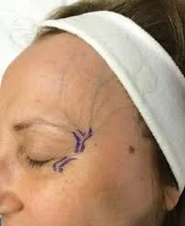 veia do rosto testa olhos