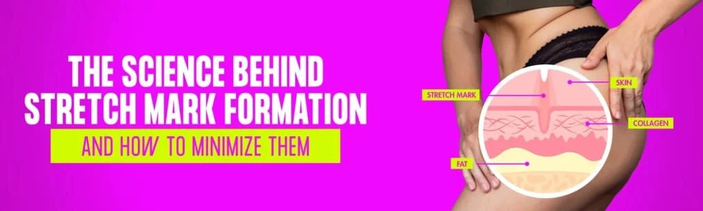 tratamento de estrias com laser