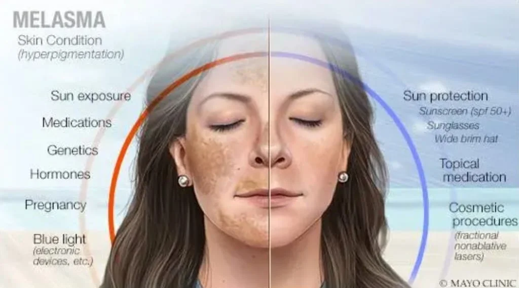 tratamento melasma especialista tratamento melasma especialista