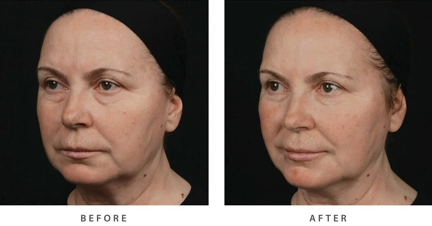 aplicação de md codes em sao paulo especialista