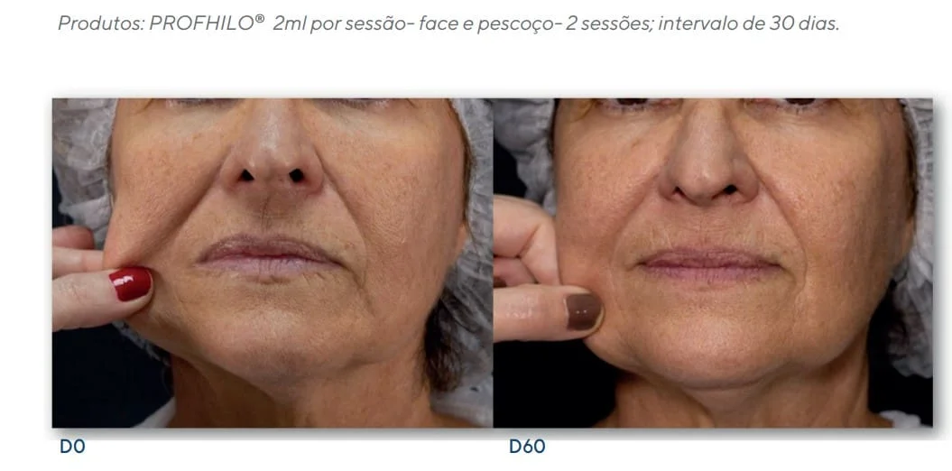 como funciona aplicaco do profhilo