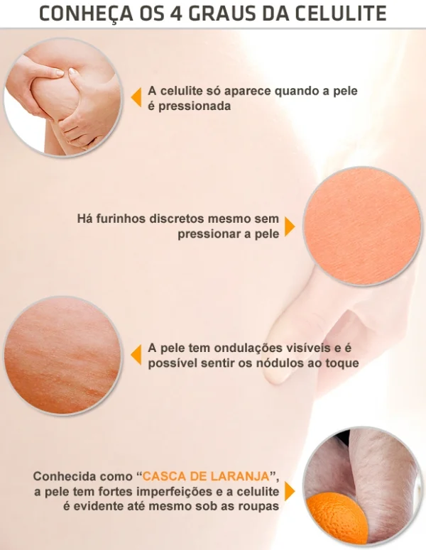 graus de celulite