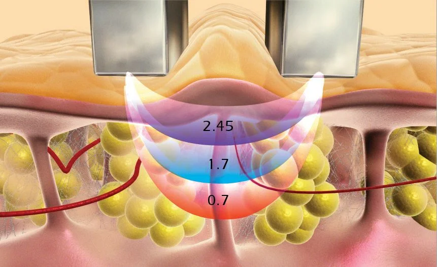 Flacidez-e-Rejuvenescimento-Osasco-sao-paulo