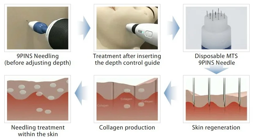 MICROAGULHAMENTO E DERMAROLLER MICROAGULHAMENTO E DERMAROLLER