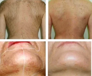 depilação laser antes e depois depilação laser antes e depois