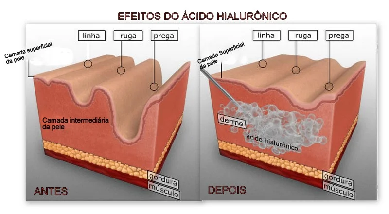 harmonizacao-preenchedor-restylane acido hialuronico emervel - juvederm
