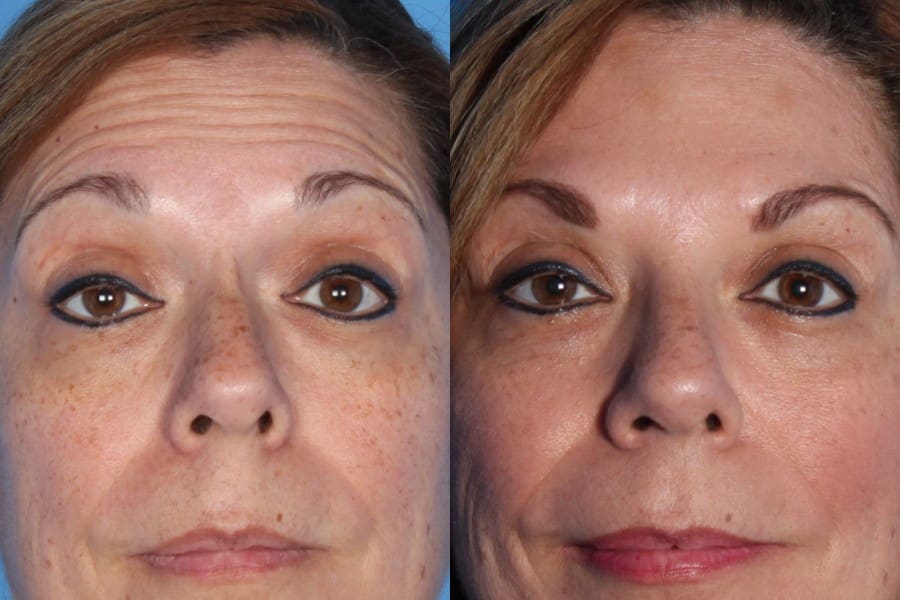 before-botox-forehead-and-after-1-week-e1387804006920 - Clinica