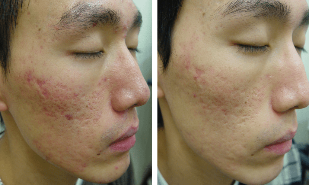 Laser fracionado co2 cicatiz de acne Clinica