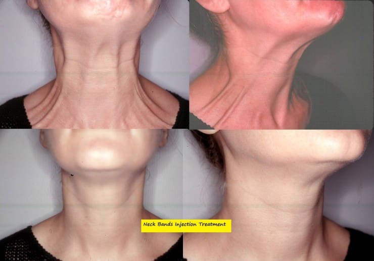 neck-bands-botox1-e1390324883267 - Clinica WulkanEspecialista