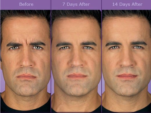 toxina-botulinica-botox-antes-e-depois-homem - Clinica