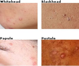 Tipos de acne