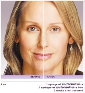 Preenchimento Facial Ácido Hialurônico - Juvederm