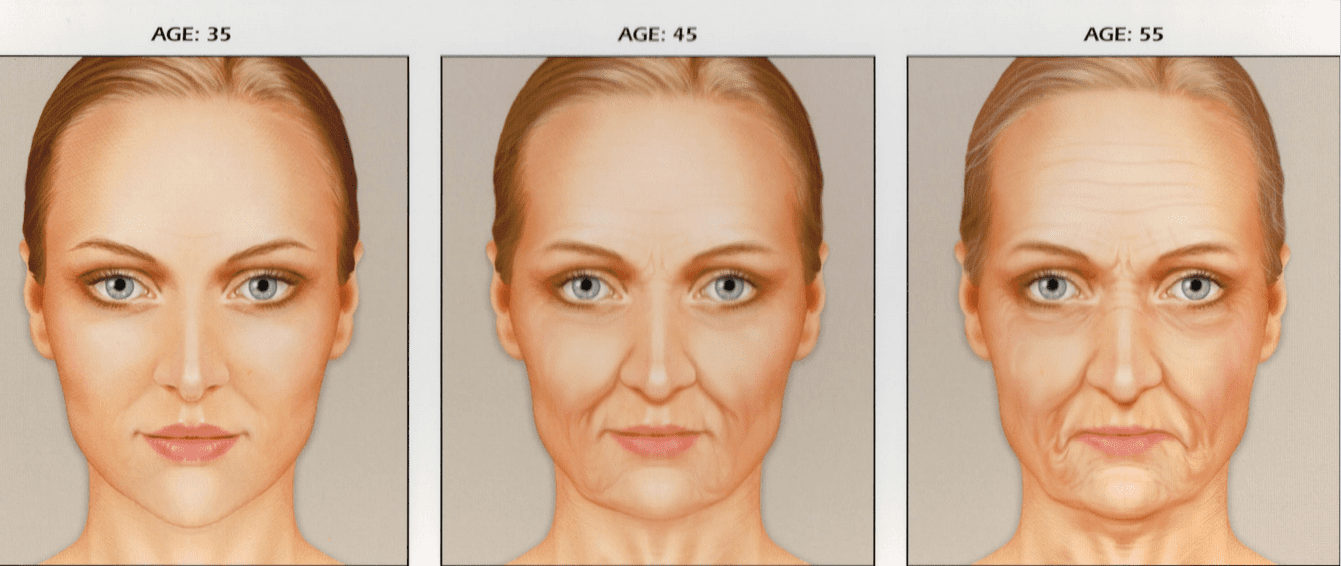 preenchimento com acido hialuronico restylane perlane juvederm face sao