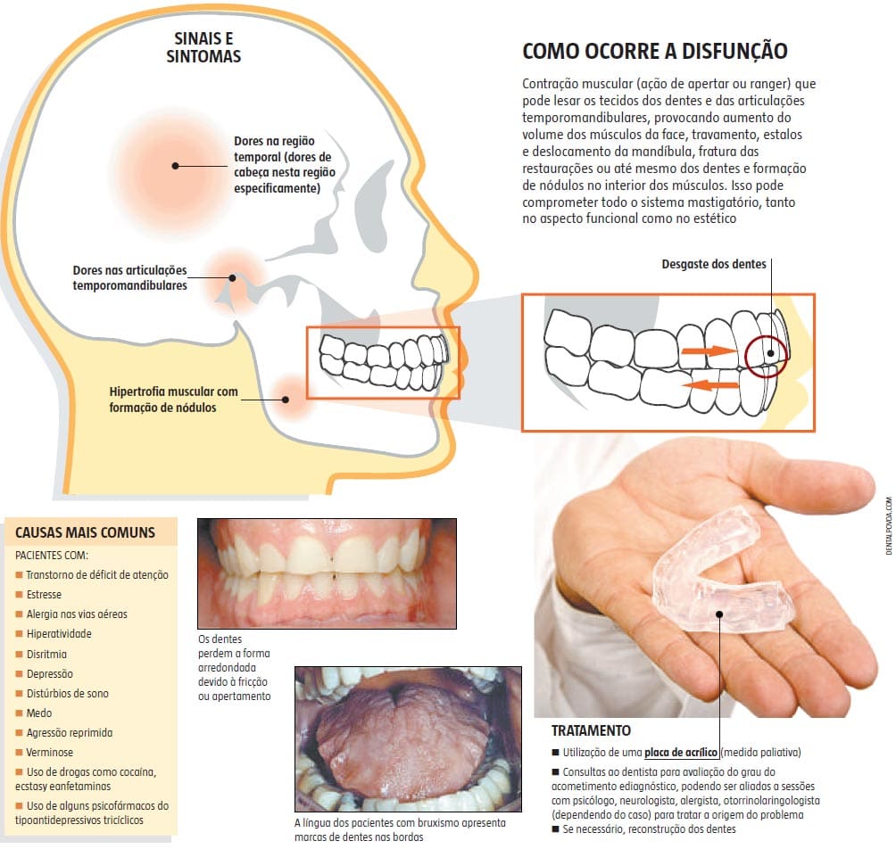 Toxina Botulínica/Botox para Bruxismo - Masseter - Dermatologista -  Especialista- Lasers, Preenchimento e Botox São Paulo