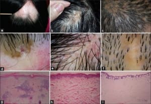 Tratamento calvicie queda de cabelo e alopecia em sao paulo homem mulher tricoscopia dermatoscopia
