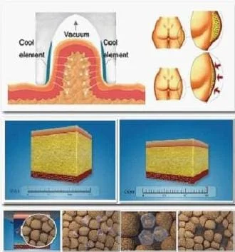 criolipolise tratamento em sao paulo