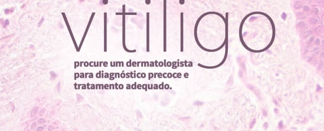 clinicawulcan 12 Manchas de Vitiligo Não Doem