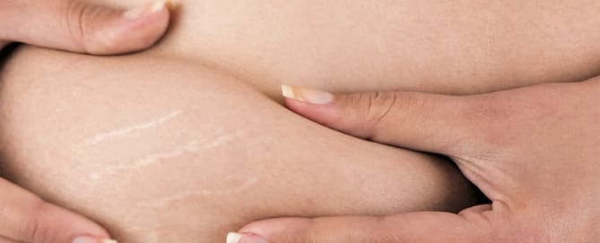 clinicawulcan 16 As estrias são lesões irreversíveis