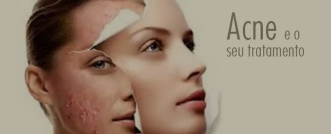 Acne e o seu tratamento 2 clinicawulcan 03 Acne e o seu tratamento