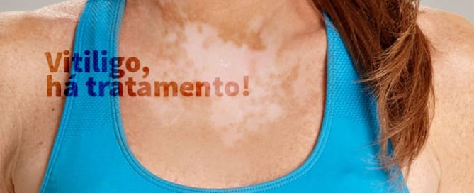 clinicawulcan 01 Vitiligo, há tratamento!