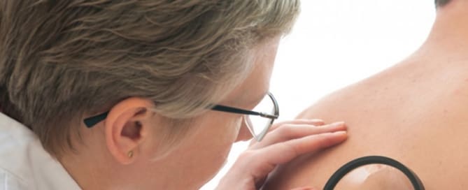 Sinais e Sintomas do Câncer de Pele