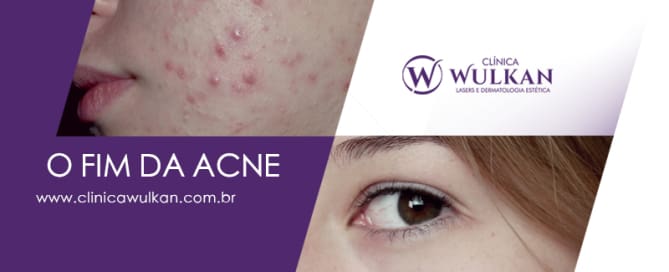o fim da acne