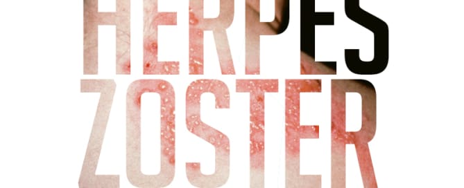 Herpes zoster
