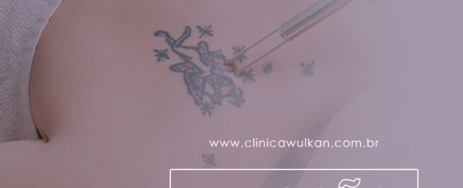 Revolução do negócio: remoção de tatuagem