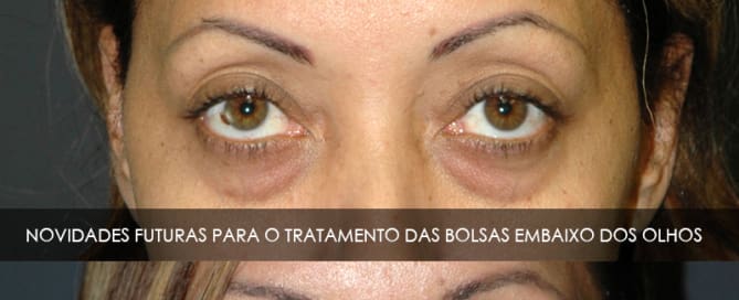Tratamento das bolsas embaixo dos olhos