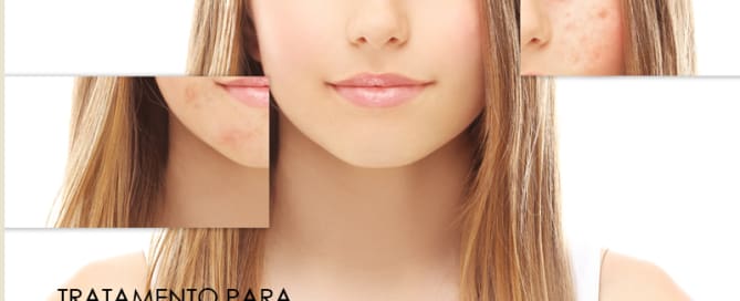 Tratamento para cicatrizes de acne
