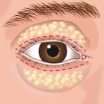 Cirurgia palpebra dos olhos - palpebra