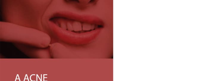 A acne pode ser particularmente frustrante para adultos.