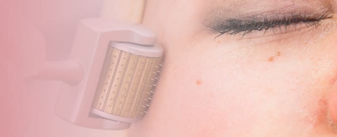 clinicawulkan 04 Microagulhamento na Dermatologia