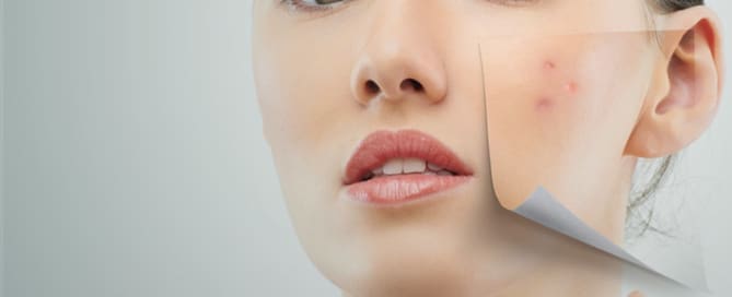 Cicatriz de acne é um estigma.