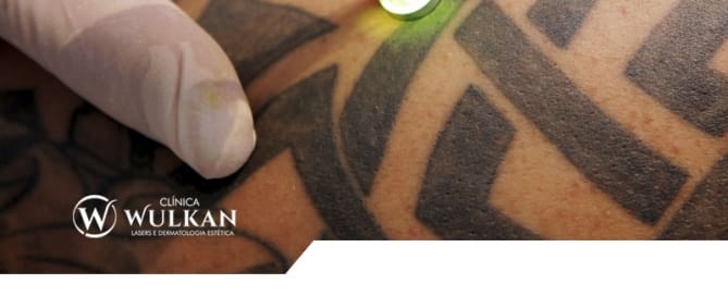 Remoção de tatuagem a laser