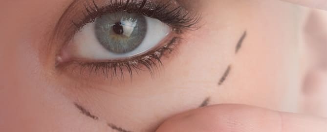 Blefaroplastia (Plástica das pálpebras)