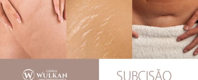 Subcisão: tratamento de cicatrizes, estrias e celulite