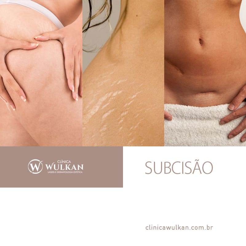 Subcisão: tratamento de cicatrizes, estrias e celulite - Dermatologista  Especialista - São Paulo