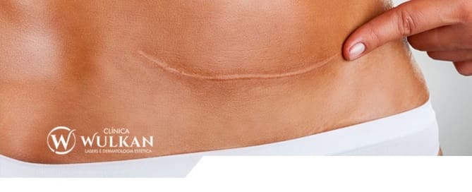 Tratamento das cicatrizes após cirurgias