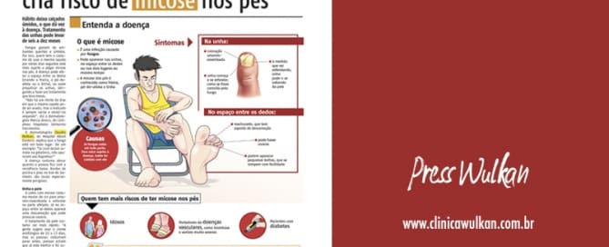 Usar o mesmo sapato todo dia cria risco de micose nos pés