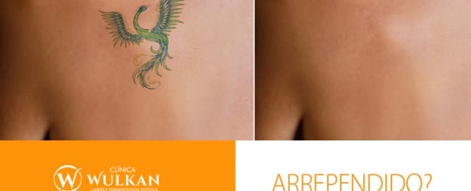 Remoção de Tatuagem a Laser