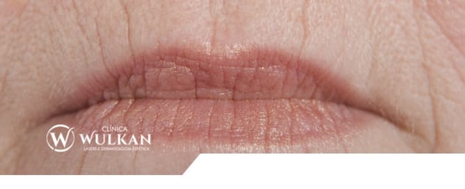 Rugas ao redor dos lábios